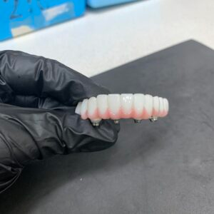 Full Arch Implant - Uptown Dental Lab