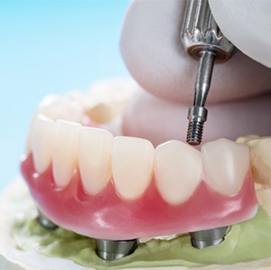Removable Prosthesis- Uptown Dental Lab