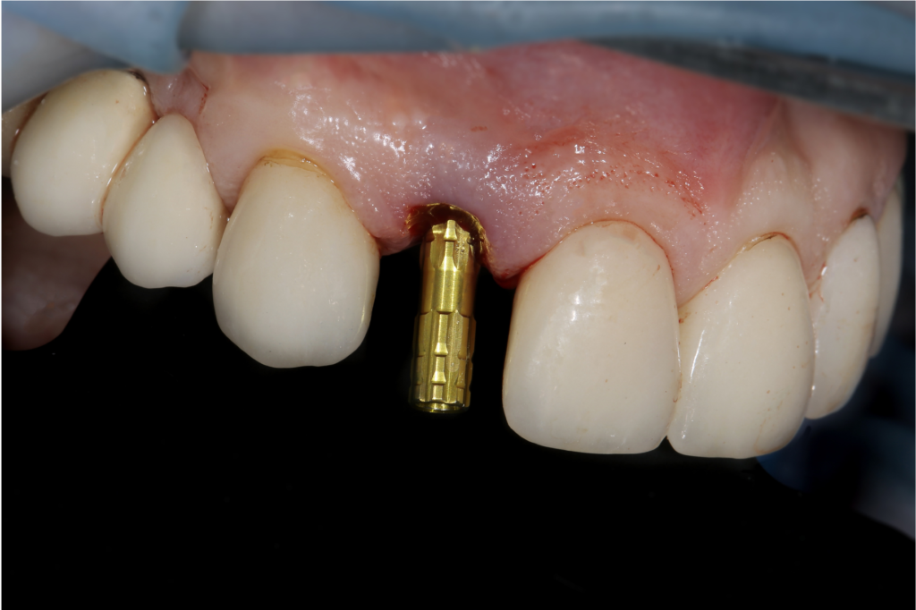 dental abutment cost - Uptown Dental Lab