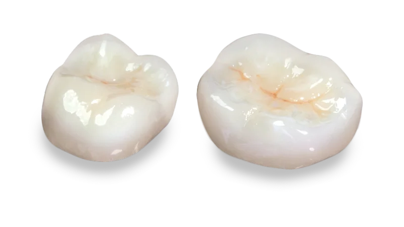 Lava Dental Crown - Uptown Dental Lab