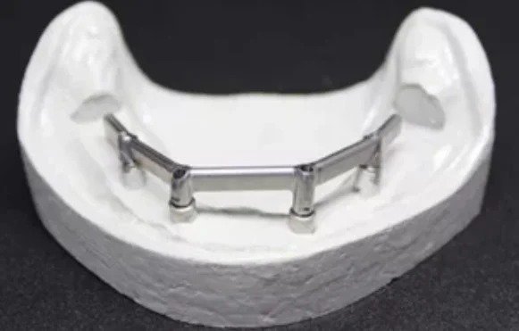 Dental implant bar framework on a lower jaw model for full arch restoration