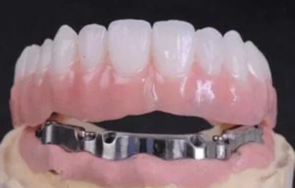 Full arch dental implant prosthesis with pink gums and metal implant framework