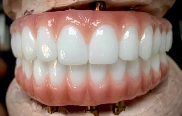 Dental implant full arch restoration with natural-looking teeth