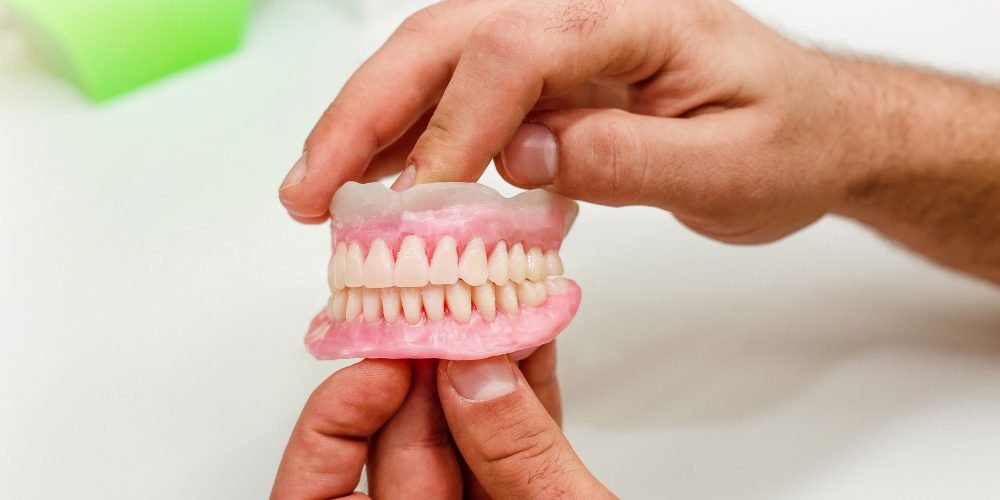 All On 4 Zirconia Hybrid Screw Retained Prosthesis